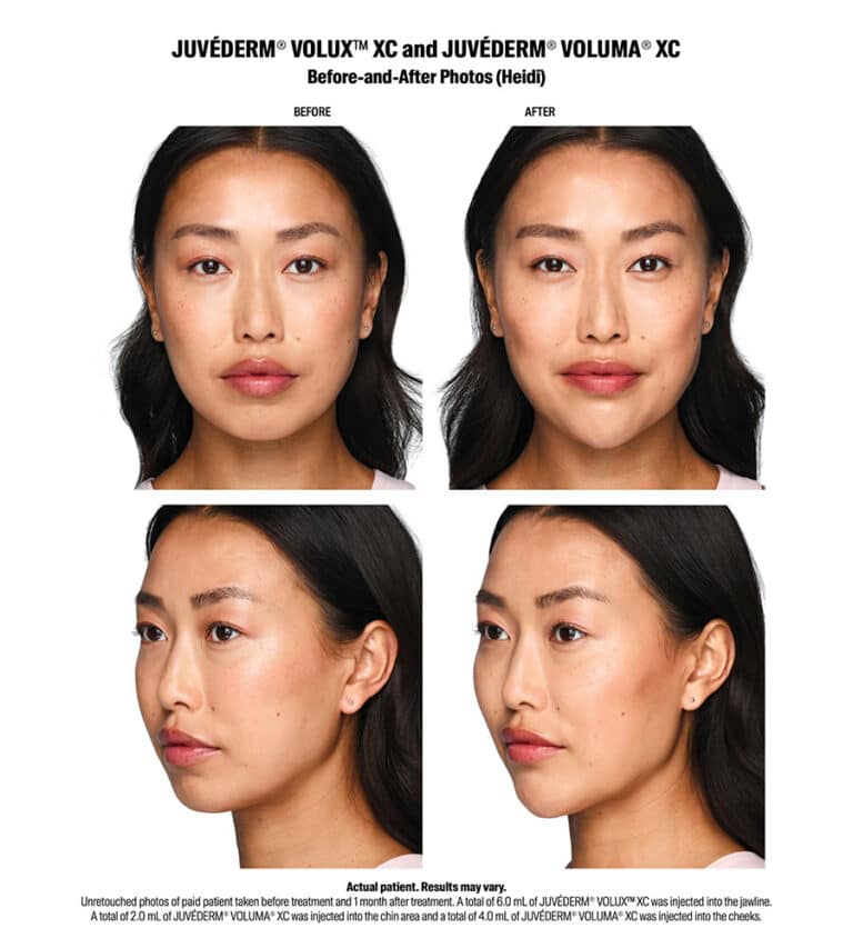 Volux Before and After Results