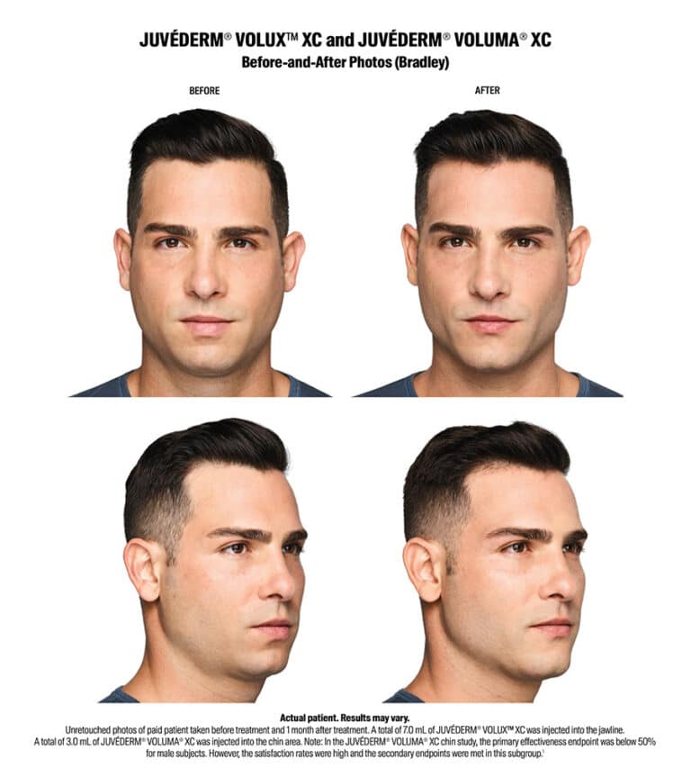 Volux Before and After Results