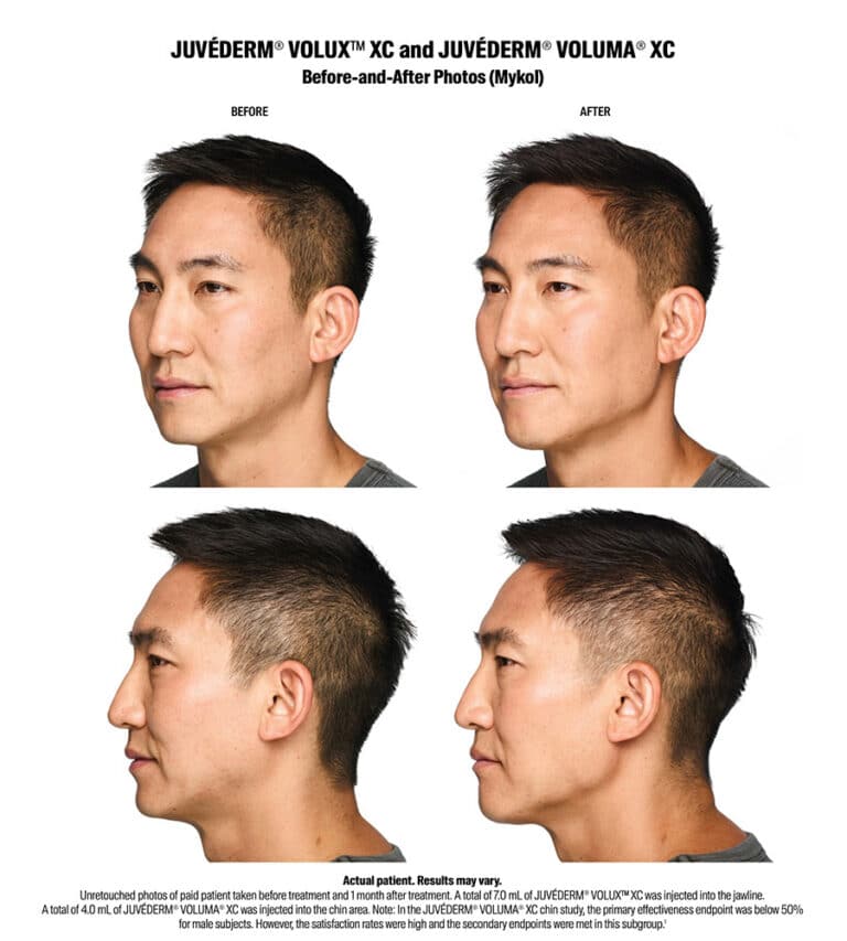 Volux Before and After Results