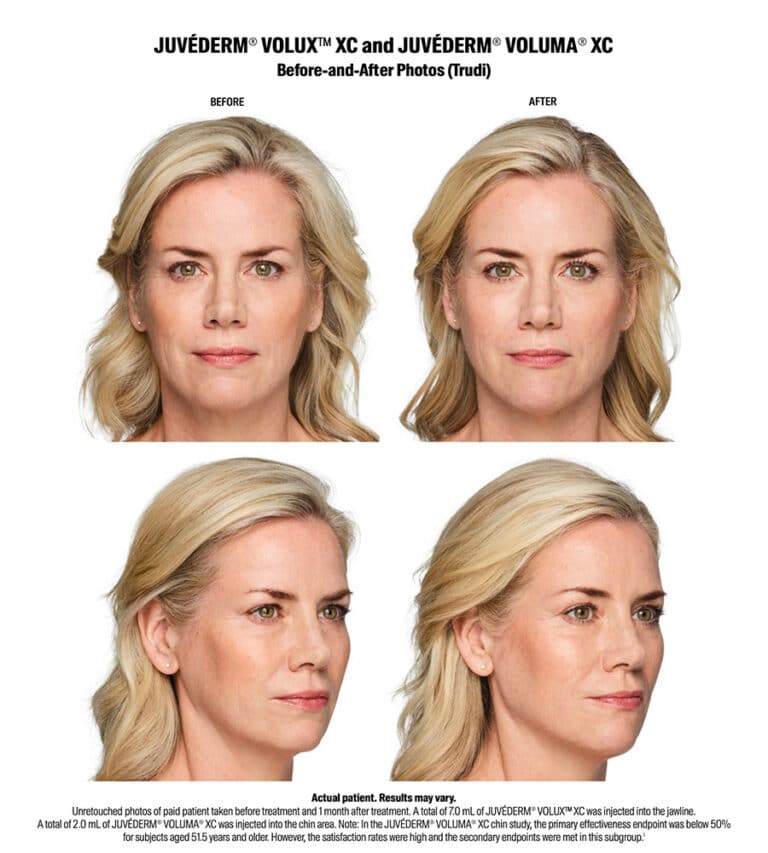 Volux Before and After Results