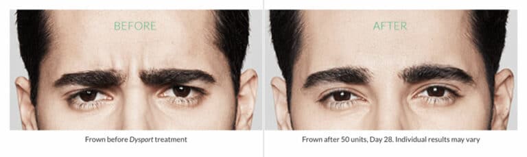 Dysport before after for men