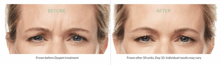 Dysport before after for women