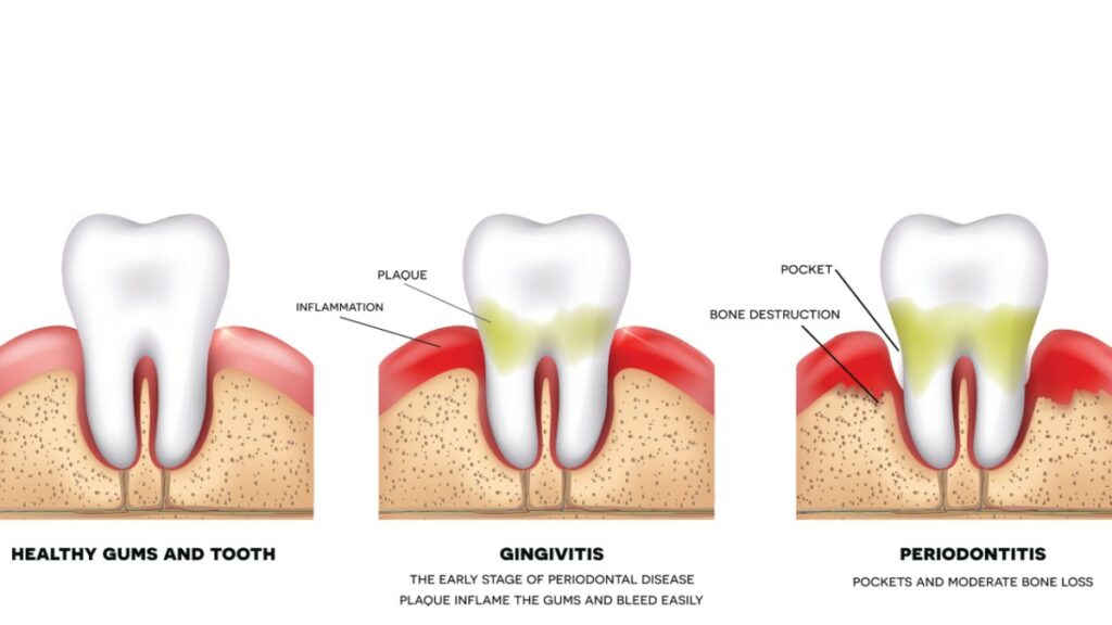 Bleeding gums Las Vegas