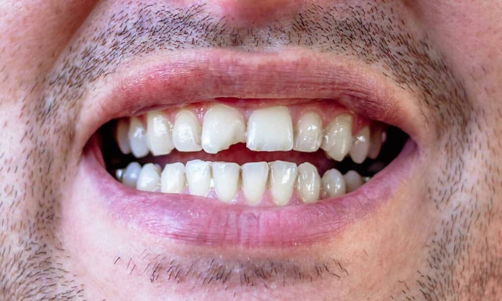 Cosmetic Bonding Las Vegas