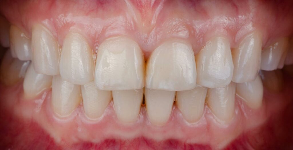 Gummy smile fix Las Vegas