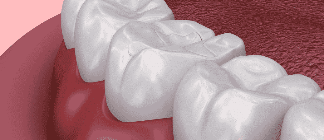 Dental Treatments Fillings, Root Canal, and Infection Control