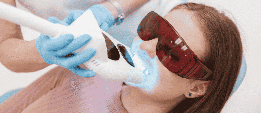 teeth whitening before veneers